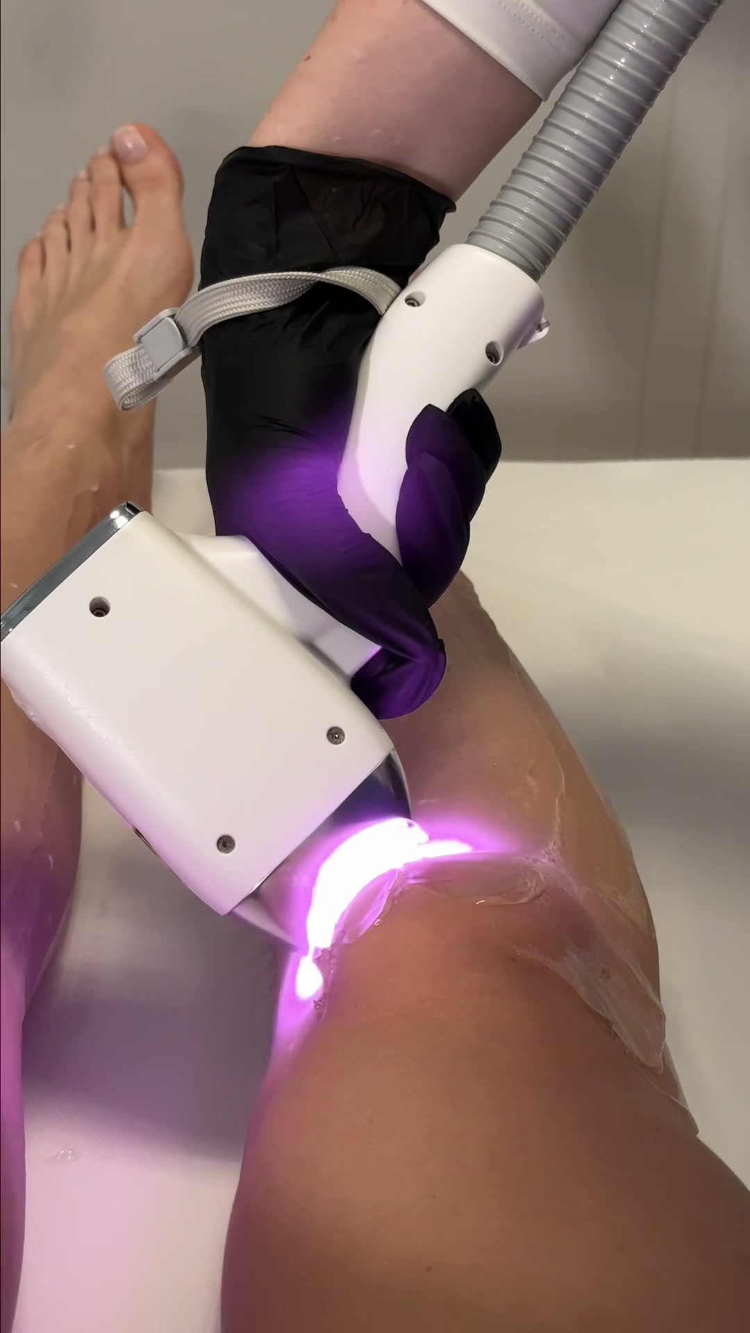 Laser hårborttagning på ben